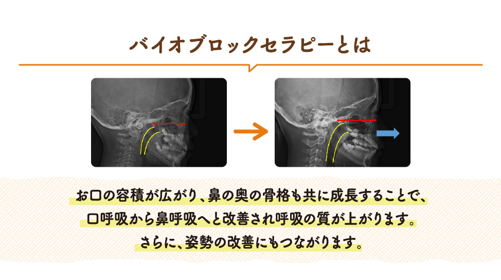 バイオブロック・セラピー －自然成長誘導法－